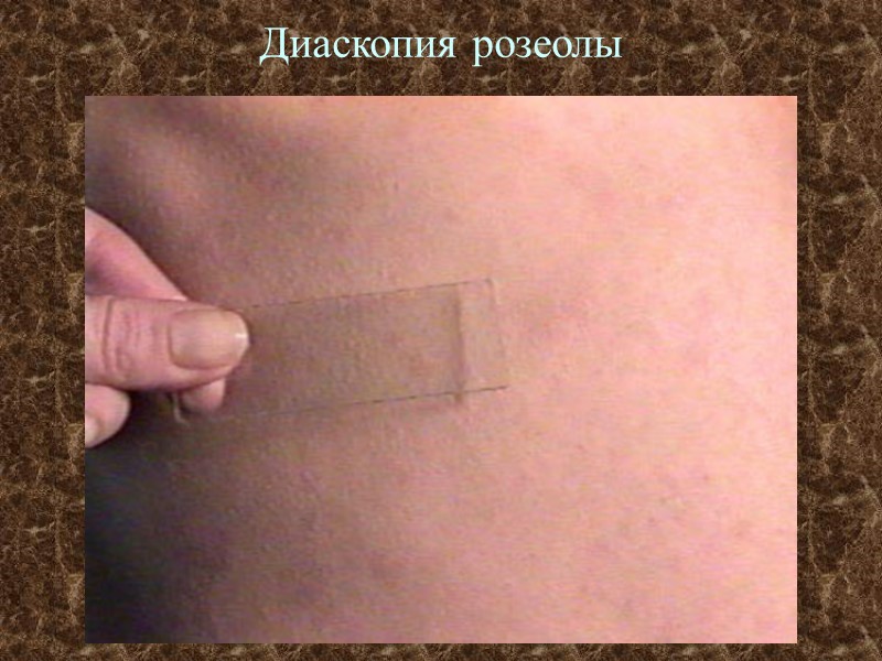 Диаскопия розеолы